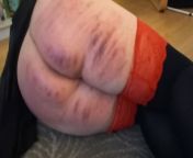 Layering bruises after a caning session 4 days ago from ssbbw bellyflation expansion morph request bbw balloon belly expansion ssbbw balloonian